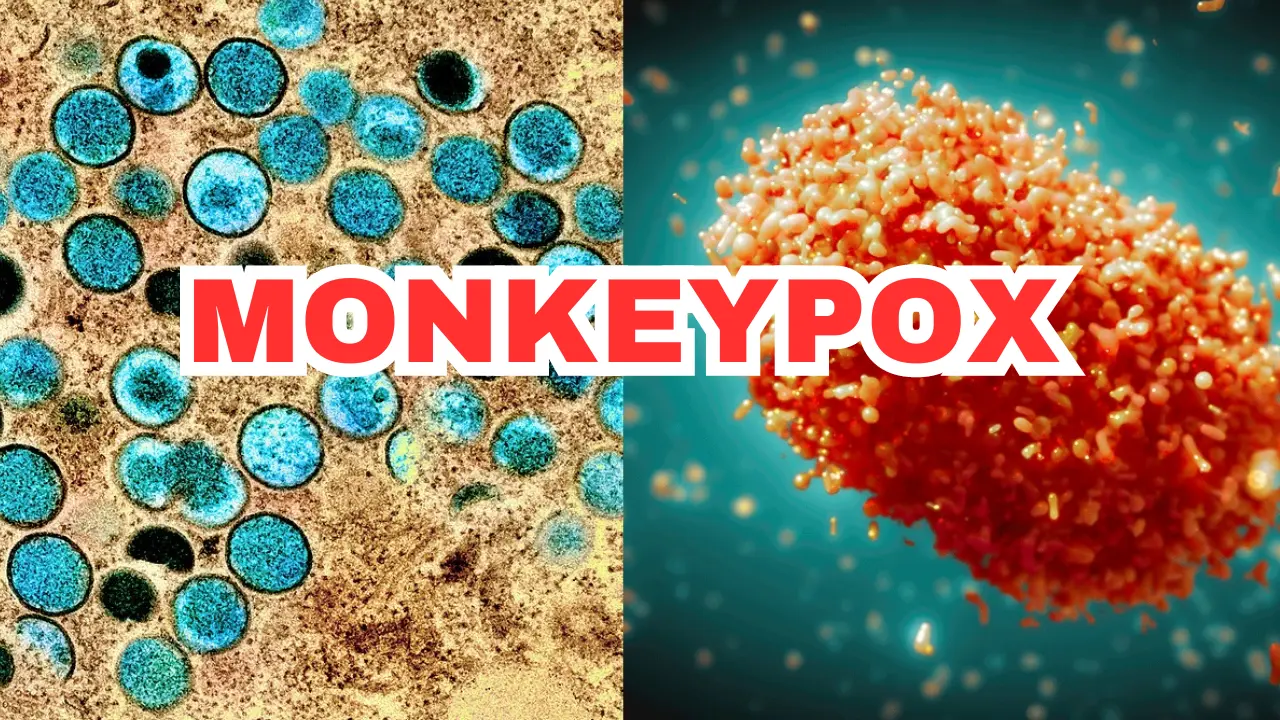 HEALTH BULLETIN: RISK OF MONKEYPOX IN RMI LOW, BUT PUBLIC AWARENESS ENCOURAGED